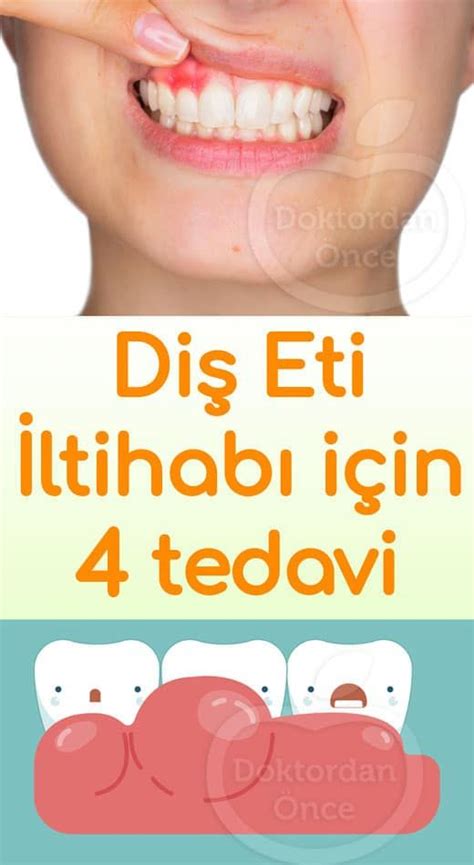 diş iltihabı doğal tedavi